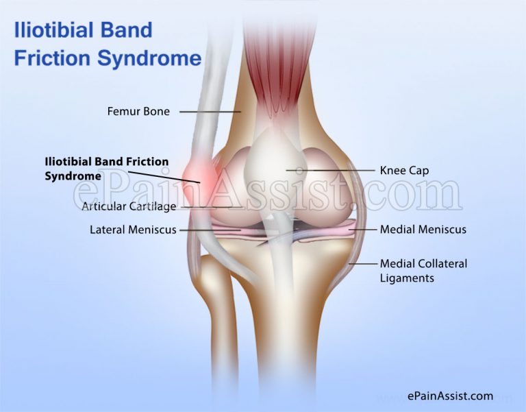 IT Band Syndrome or Iliotibial Band Friction Syndrome (ITBS or ITBFS)