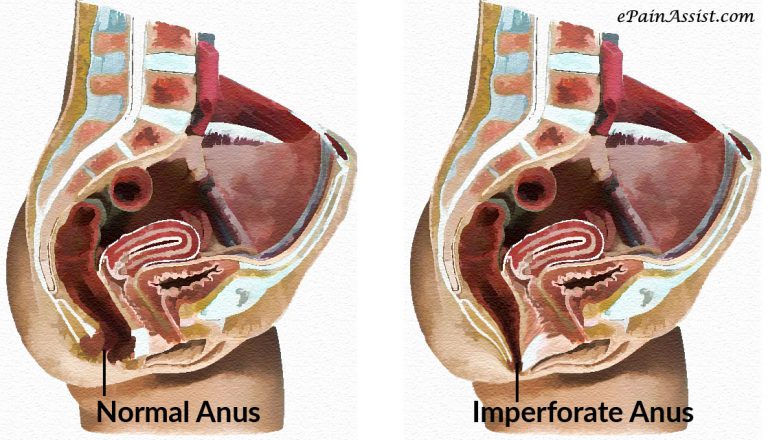 Imperforate Anus: Causes, Complications, Symptoms, Treatment, Prognosis