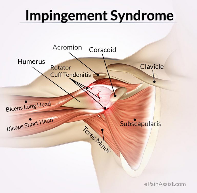 Impingement Syndrome or Rotator Cuff Tendinitis: Causes, Symptoms, Diagnosis, Treatment, Exercise, Home Remedies