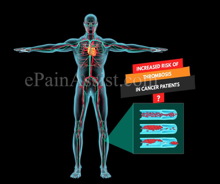 Increased Risk of Thrombosis in Cancer Patients