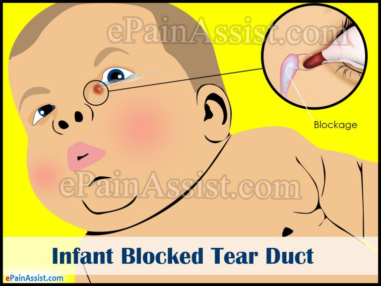 Infant Blocked Tear Duct : Causes, Symptoms, Tests, Treatment, Surgery