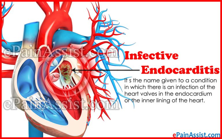 Infective Endocarditis: Causes, Symptoms, Treatment