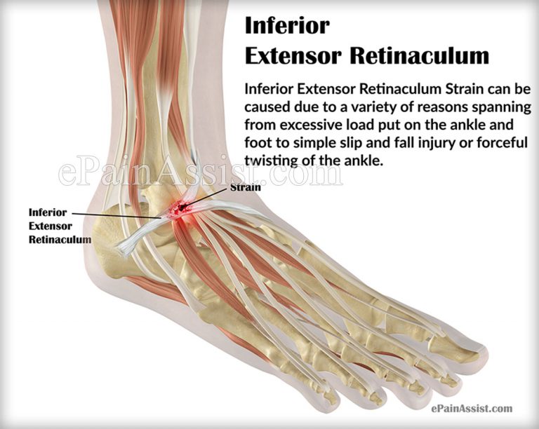 Inferior Extensor Retinaculum Strain