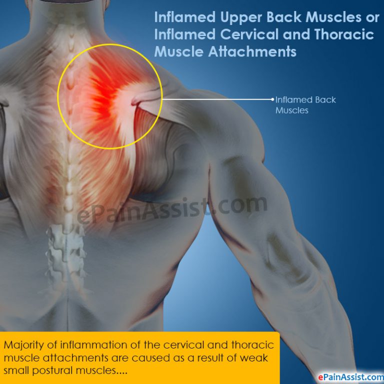 Inflamed Upper Back Muscles or Inflamed Cervical and Thoracic Muscle Attachments: Causes, Symptoms, Diagnosis, Treatment