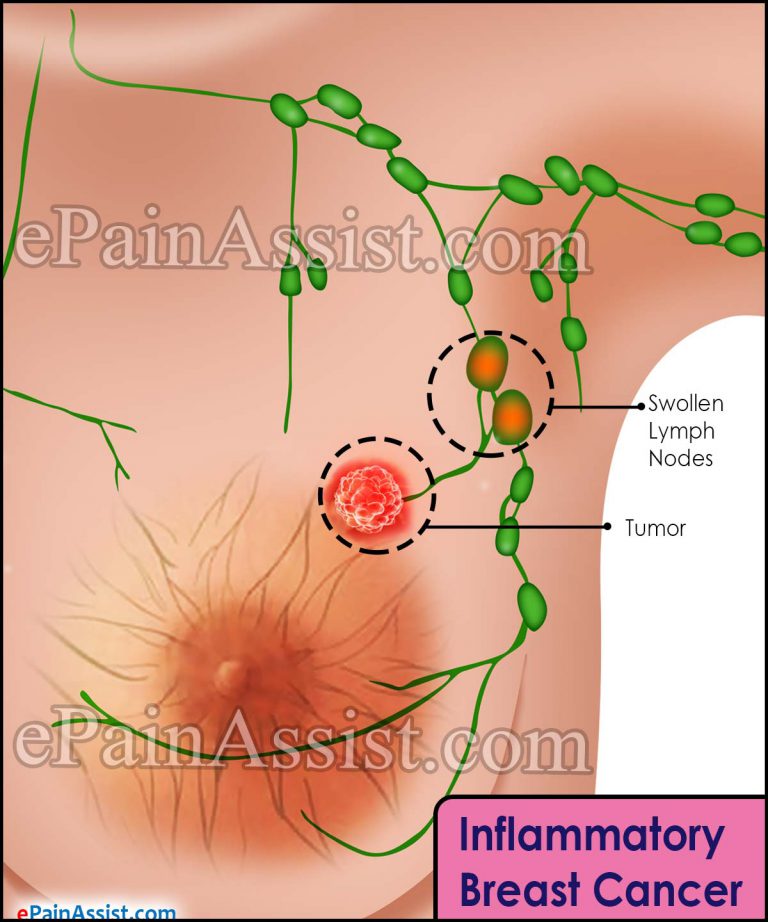 Inflammatory Breast Cancer: Causes, Symptoms, Treatment, Prevention
