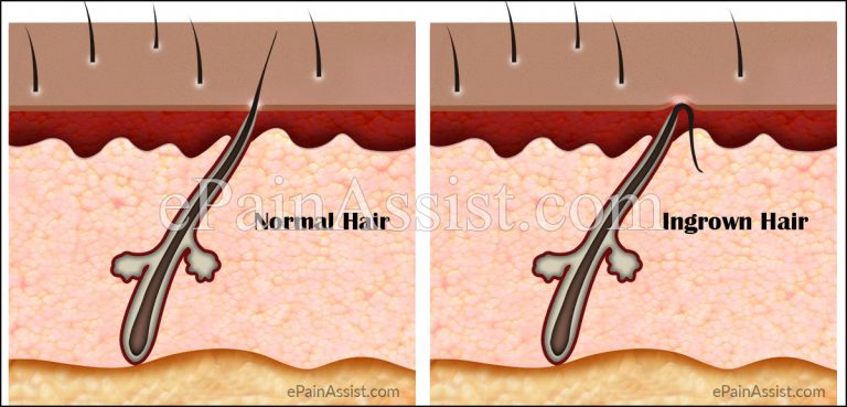 What Causes Ingrown Hair and How to Get Rid of it?