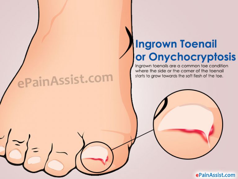 Ingrown Toenail or Onychocryptosis: Causes, Signs, Symptoms, Investigations, Treatment, Home Remedies, Prevention