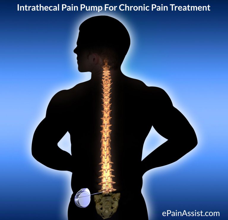 Intrathecal Pain Pump For Chronic Pain Treatment. Who Should Consider it?