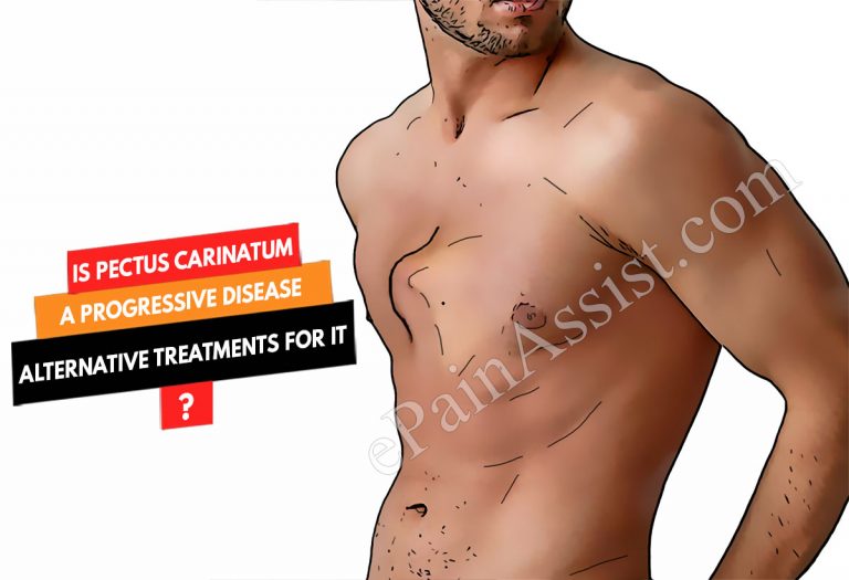 Is Pectus Carinatum A Progressive Disease & Alternative Treatments For It?