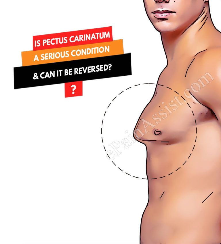 Is Pectus Carinatum A Serious Condition & Can It Be Reversed?
