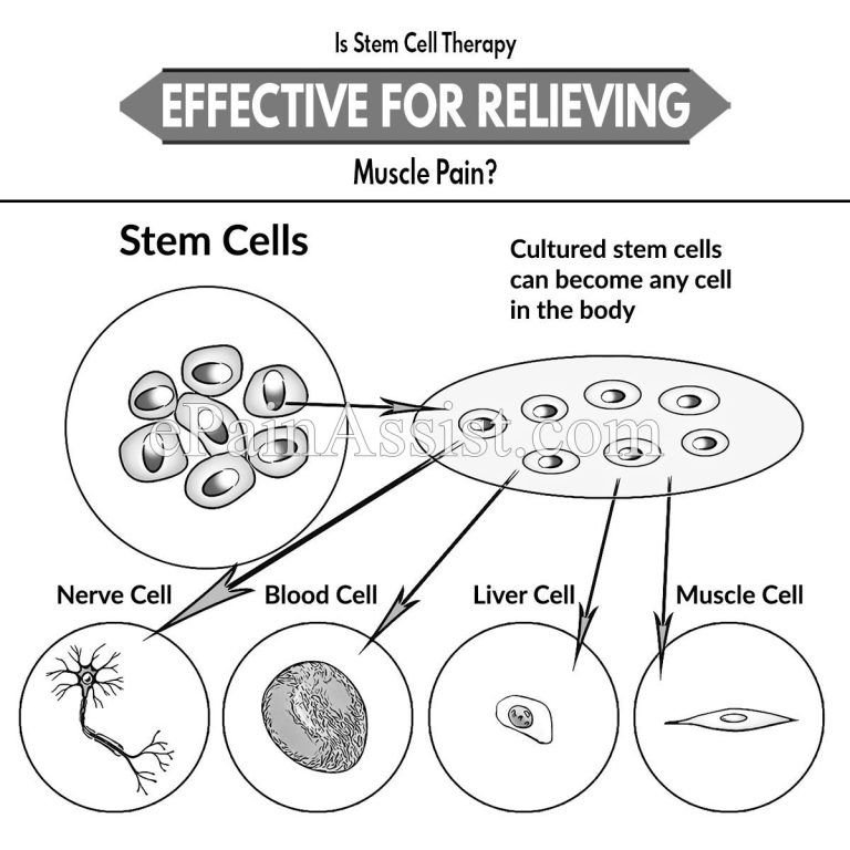 Is Stem Cell Therapy Effective for Relieving Muscle Pain?