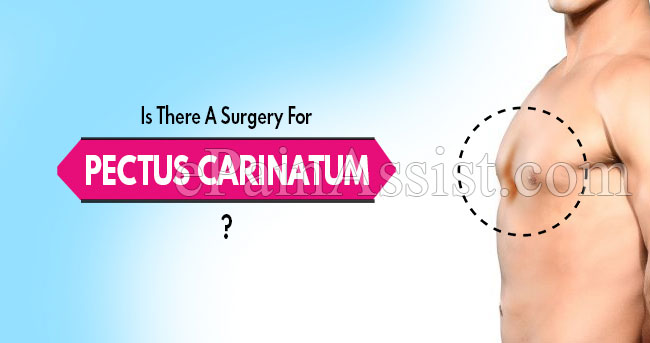 Is There A Surgery For Pectus Carinatum? Is There A Surgery For Pectus Carinatum?