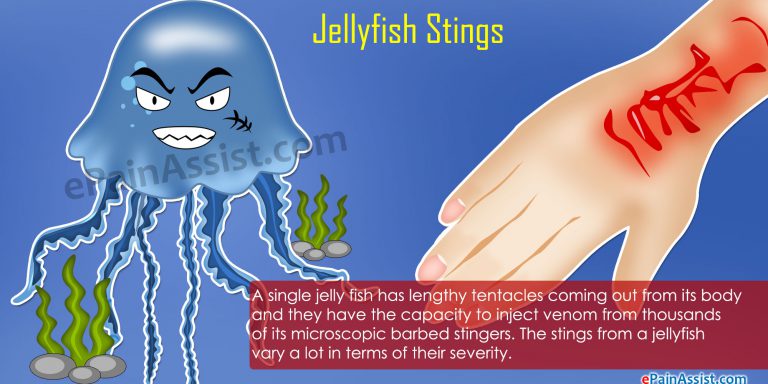 Jellyfish Stings: Signs, Symptoms, First Aid, Treatment, Prevention