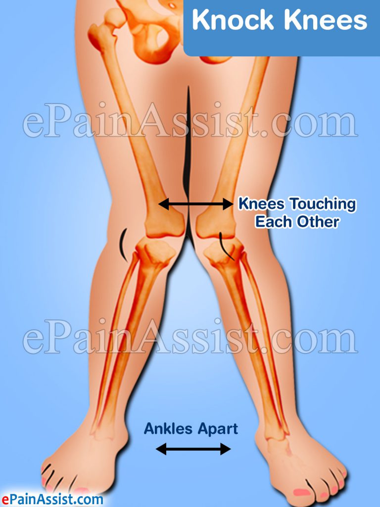 Knock Knees: What Can Cause Genu Valgum And How To Fix It?