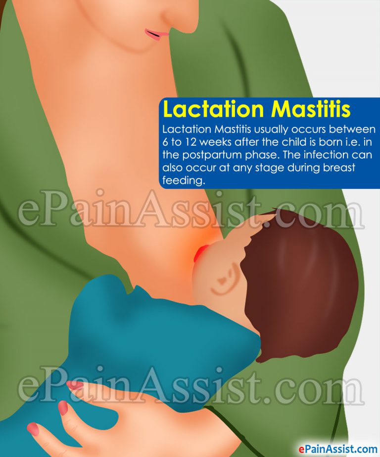 Lactation Mastitis: Causes, Symptoms, Treatment, Prevention, Lifestyle Changes