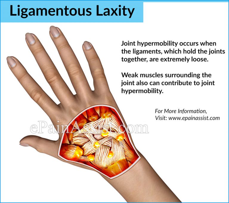 Ligamentous Laxity: Causes, Signs, Symptoms, Treatment, Diagnosis