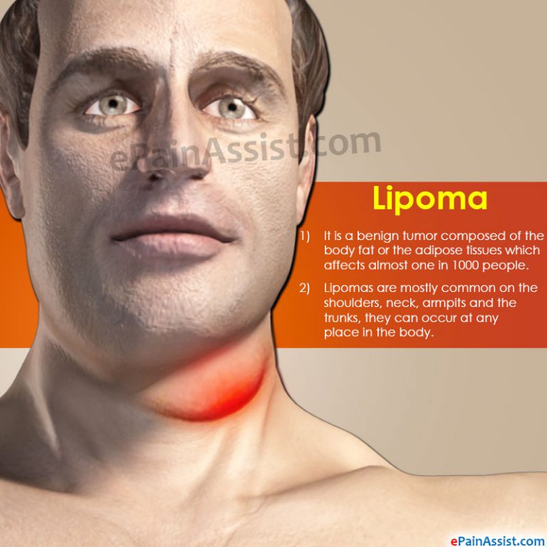 Lipoma: Symptoms, Causes, Treatments, Herbal Remedies, Prognosis, Epidemiology