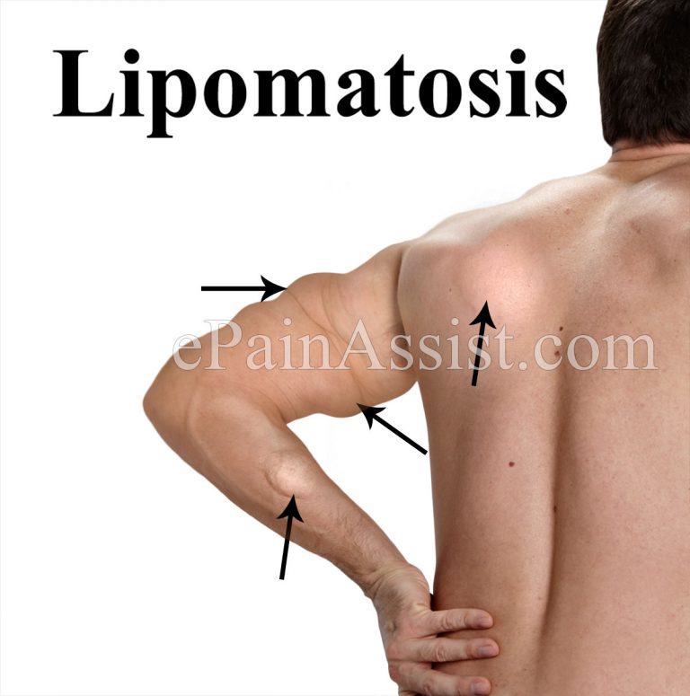 Lipomatosis : Causes, Diagnosis, Treatment