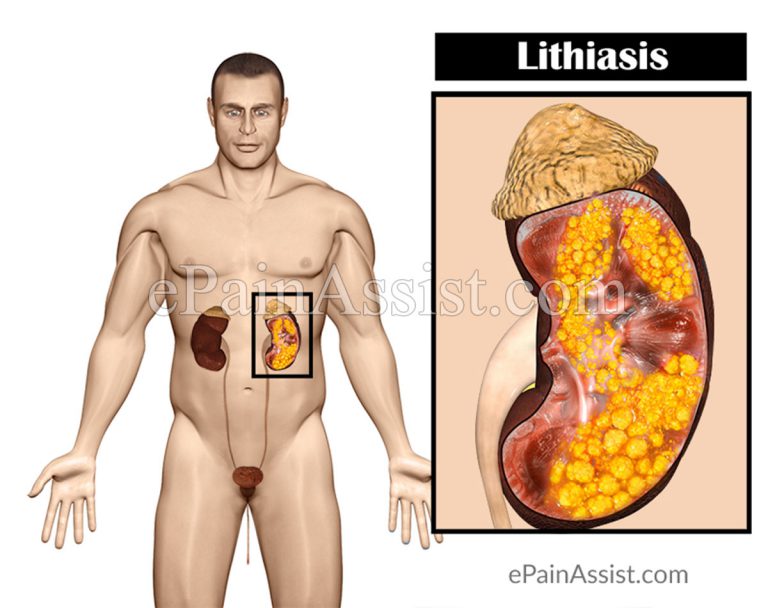 Lithiasis or Calculus: Symptoms, Types, Treatment, Prevention, Diagnosis