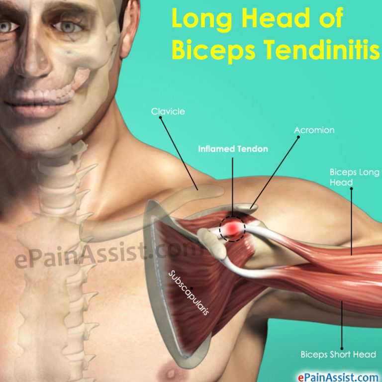Long Head Of Biceps Tendinitis: Causes, Symptoms, Diagnosis, Treatment, Exercises