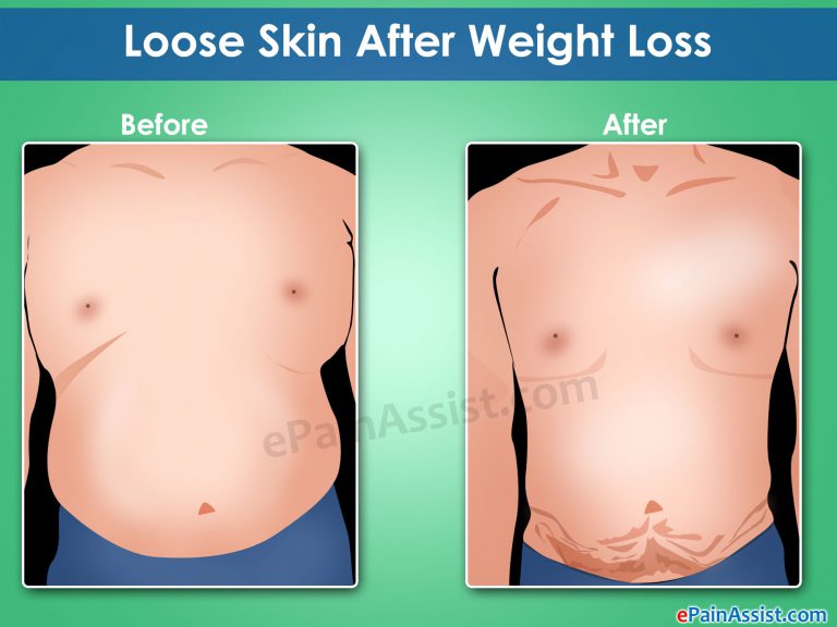 Loose Skin After Weight Loss: Non-Surgical & Surgical Ways To Tighten Excess Skin