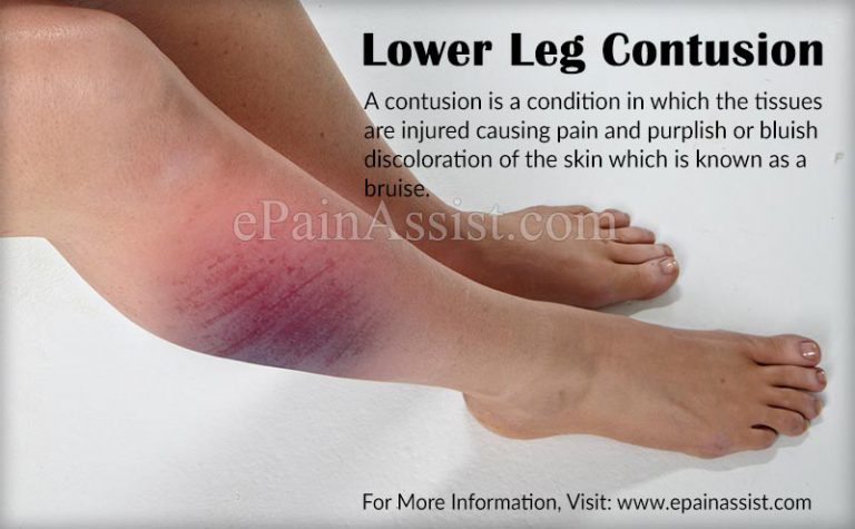 Lower Leg Contusion: Symptoms, Treatment, Stretching, Strengthening Exercises, Sports Massage