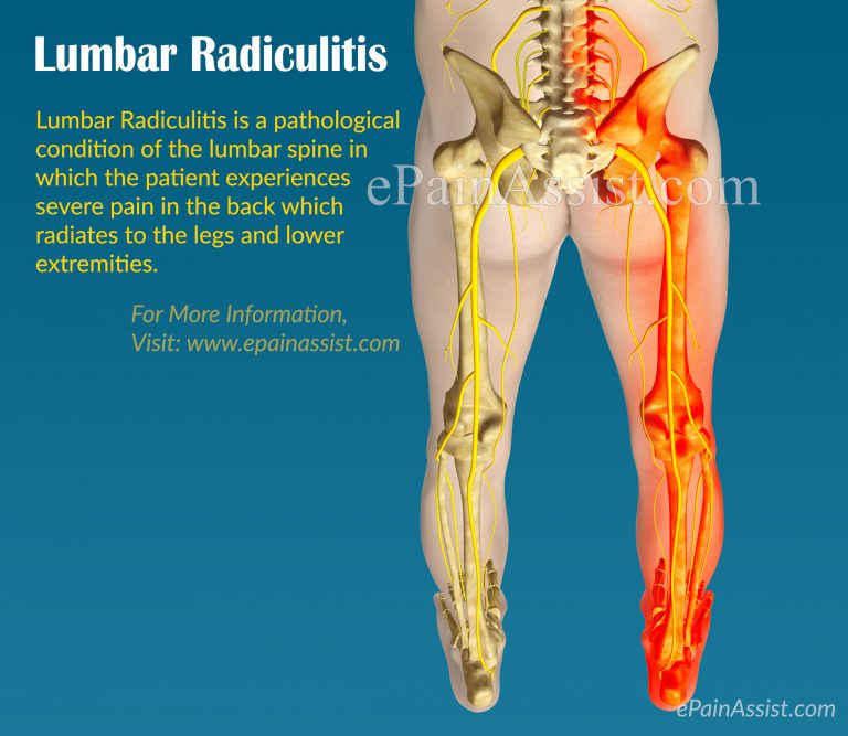 What Can Cause Lumbar Radiculitis and How is it Treated?