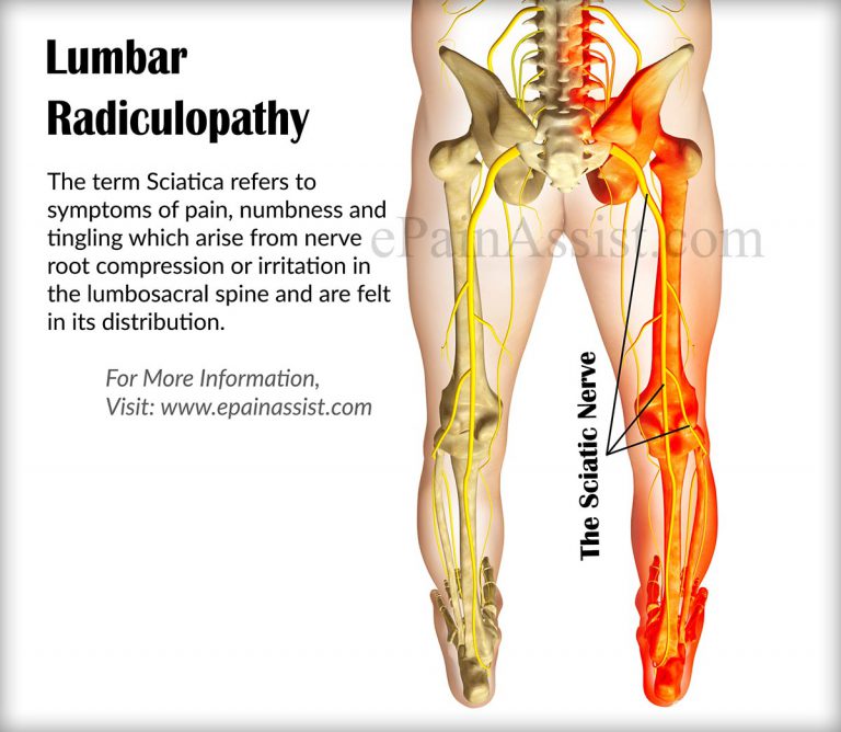 Lumbar Radiculopathy or Sciatica: Causes, Risk Factors, Signs, Symptoms, Treatment, Investigations