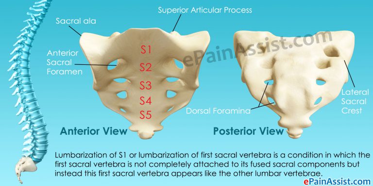 What is Lumbarization and How Can it Be Treated?