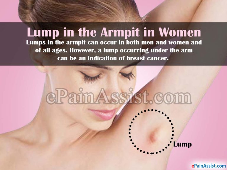 Lump in the Armpit: Causes, Symptoms, Treatment, Prognosis, Diagnosis