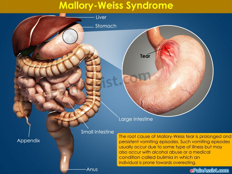 Mallory-Weiss Syndrome: Causes, Symptoms, Diagnosis, Treatment, Prognosis