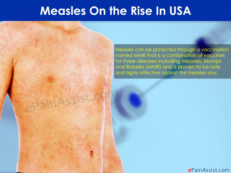 Measles On the Rise In USA !!