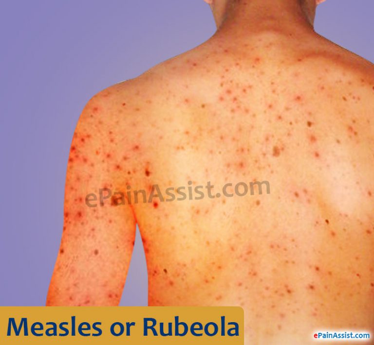 Measles or Rubeola: Causes, Risk Factors, Symptoms, Stages, Treatment, Home Remedies