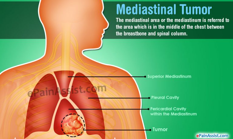 Mediastinal Tumor: Causes, Symptoms, Treatment, Prognosis