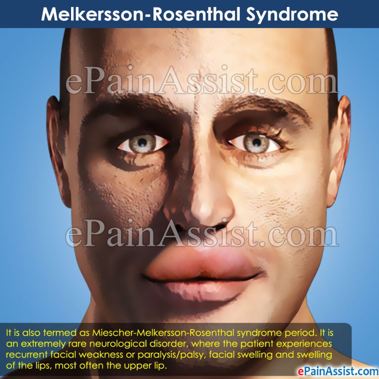 What Is Melkersson-Rosenthal Syndrome?