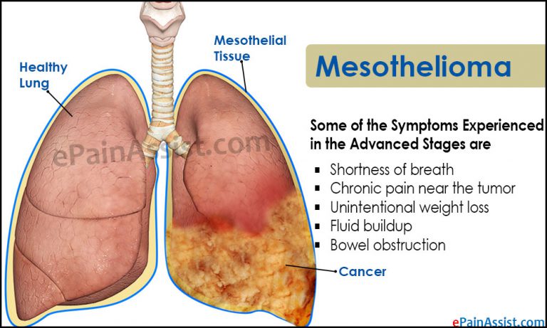 Mesothelioma: Causes, Who Is At Risk, Types, Symptoms, Diagnosis, Present Treatment, Emerging Treatment