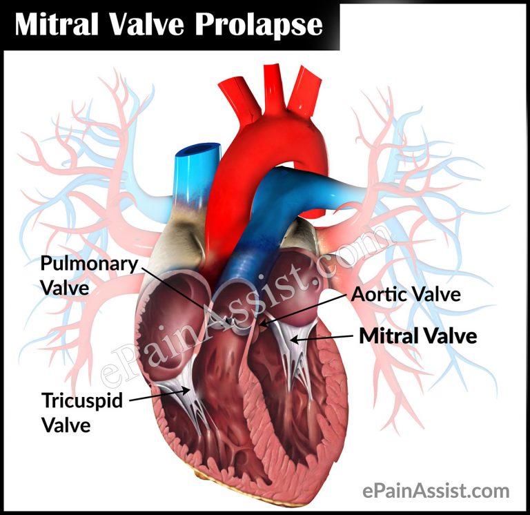 Mitral Valve Prolapse or Floppy Mitral Valve Syndrome