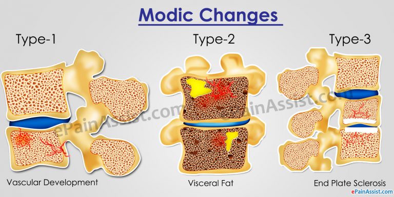 What Are Modic Changes And How Is It Treated – Know Its Significance on Back Pain