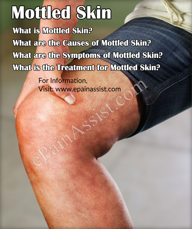 Mottled Skin|Causes|Symptoms|Treatment|Diagnosis