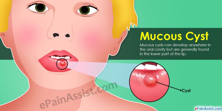 Mucous Cyst: How Long Does It Take To Heal?