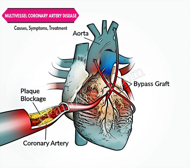 Multivessel Coronary Artery Disease: Causes, Symptoms, Treatment, Diagnosis, Prognosis