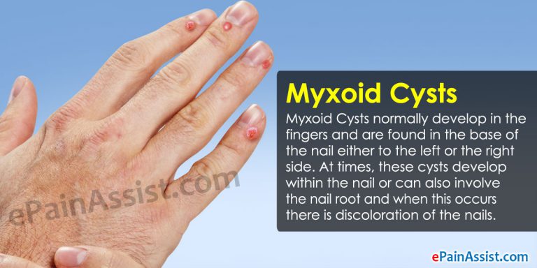 What Are Myxoid Cysts?