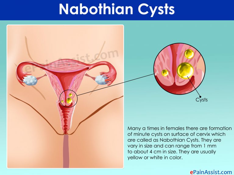 What Are Nabothian Cysts And How Is It Treated?