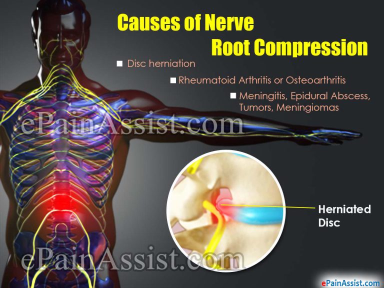 Nerve Root Compression: Causes, Symptoms, Treatment