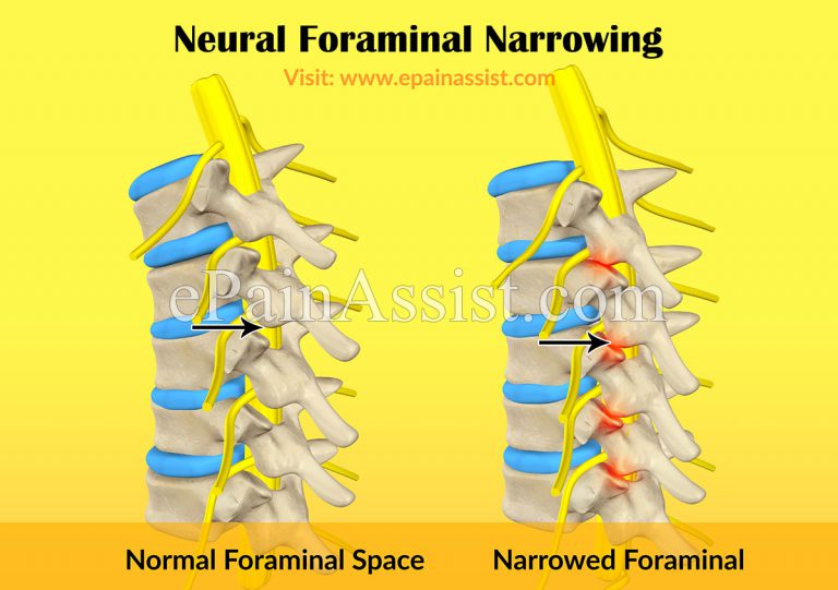 Neural Foraminal Narrowing: Causes, Symptoms, Treatment, Surgery