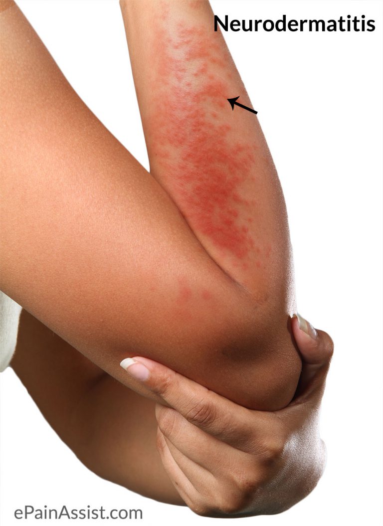 Neurodermatitis or Lichen Simplex Chronicus: Causes, Risk Factors, Investigations, Treatment, Home Remedies & Prevention