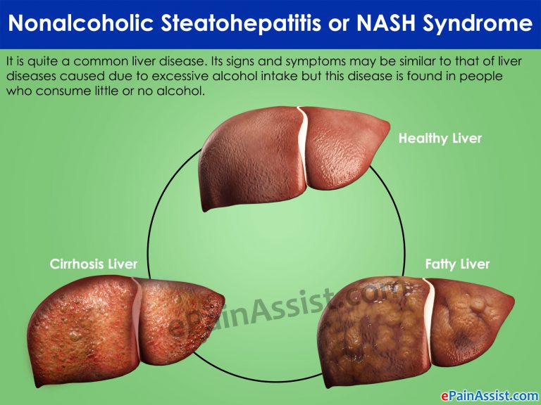 Nonalcoholic Steatohepatitis or NASH Syndrome: Causes, Symptoms, Treatment, Diet