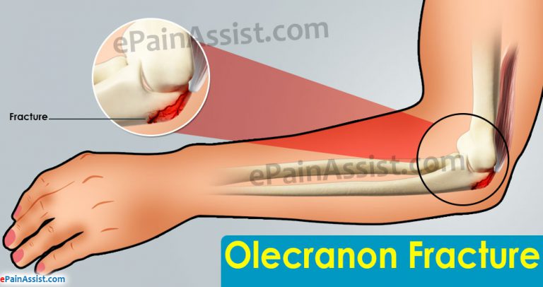 Olecranon Fracture: Symptoms, Causes, Treatment- NSAIDs, Splint, Cast, Surgery