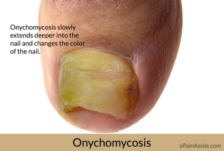 Onychomycosis: Causes, Symptoms, Treatment, Home Remedies, Prevention, Diagnosis, Signs