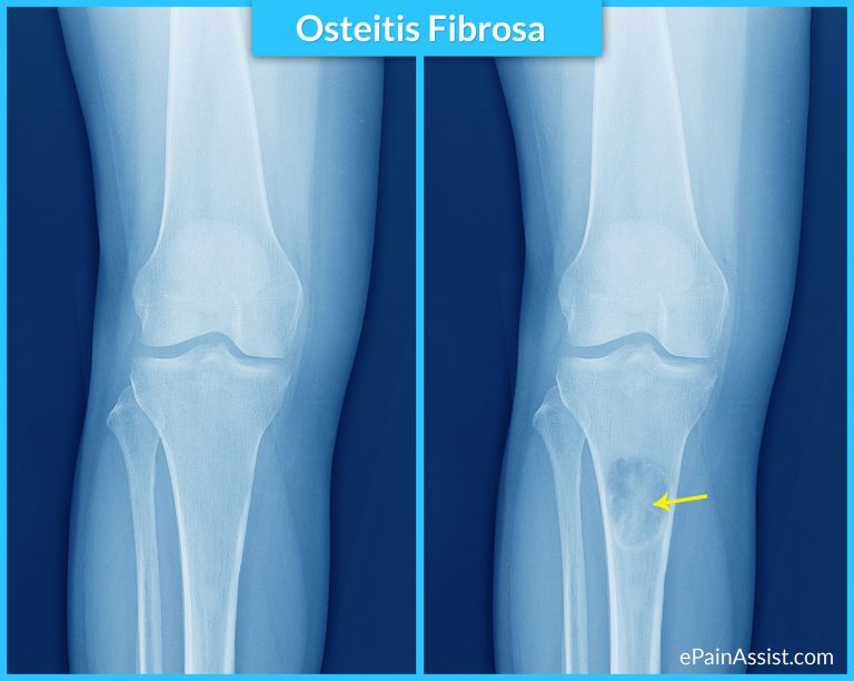 Osteitis Fibrosa: Causes, Symptoms, Diagnosis, Treatment, Complications